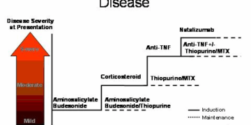New Breakthrough Treatments for Crohns Disease in 2025: A Glimpse into the Future of Treatment